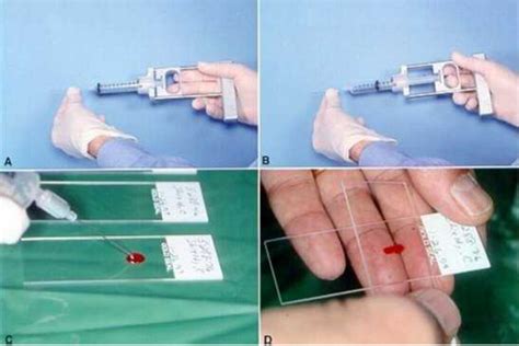 Fine Needle Aspiration Of The Thyroid Gland Endotext Ncbi Bookshelf