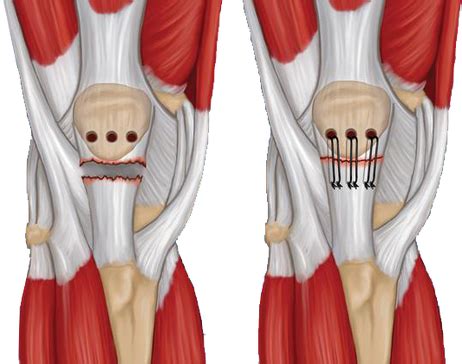 Quadriceps and Patellar Tendon Rupture - Atlanta Bone and Joint Specialists