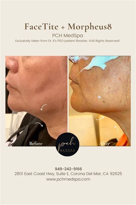 Facetite Morpheus8 Non Surgical Facelift And Skin Tightening Quick