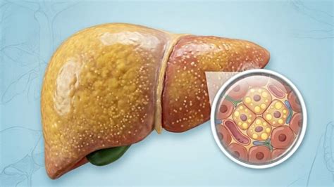 Foto De Figado Com Gordura - 4 formas naturais de limpar gordura no fígado, segundo a ciência