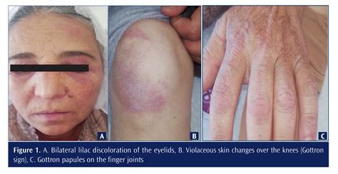 Rich Skin Manifestations In Dermatomyositis The Rheumatology