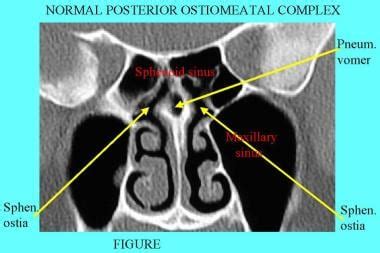 Nasal Bone Anatomy Scan : Radiology Anatomy Images : CT frontal sinuses Anatomy : And where they ...