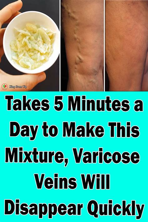 Pin On How To Treat Varicose Veins