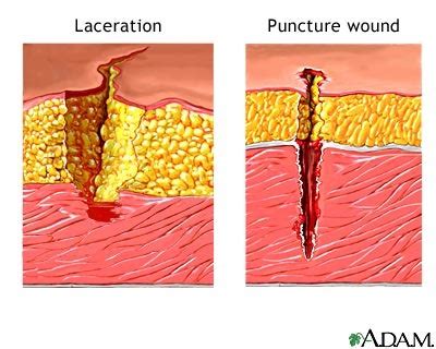 28-31. Open trauma - Wounds. Contusion and lacero-contusion Wound. Cut wounds. Bite wounds ...