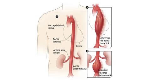 Anevrism Aortic Tipuri Simptome I Tratamente Eficace