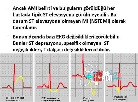 Akut Myokard İnfarktüsü Sunum Personel Sağlık Bakanlığı Haber 112acilfm Net Doktor Hemşire