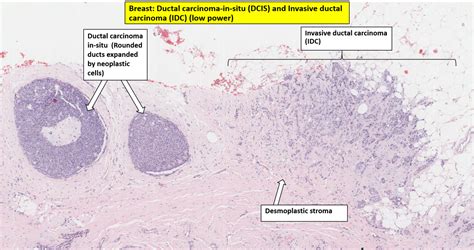 Breast Carcinoma Nus Pathweb Nus Pathweb