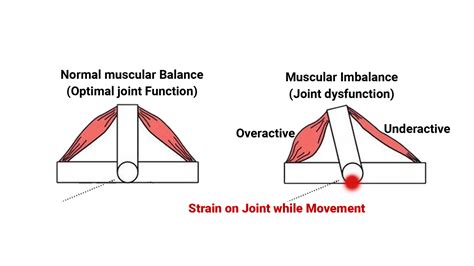 Muscle Imbalance - Dr. Amit Sarswat