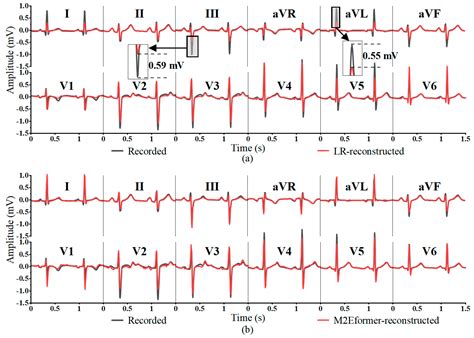 Bioengineering Free Full Text Wearable 12 Lead Ecg Acquisition Using A Novel Deep Learning