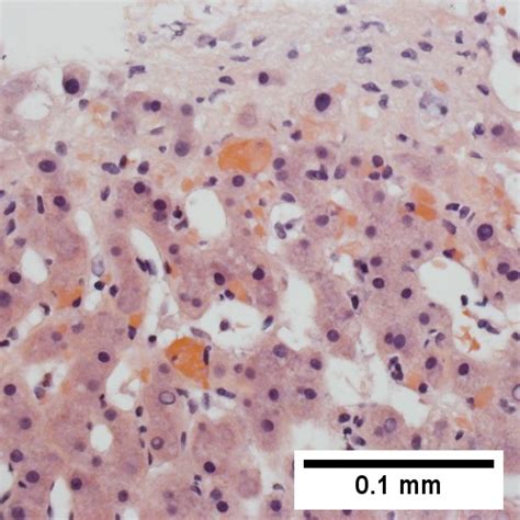 Congestive Hepatopathy Libre Pathology