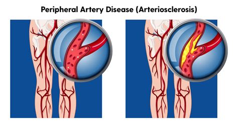 Peripheral Arterial Disease And The Feet My Footdr