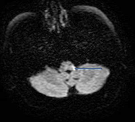 Diffusion Weighted Axial Mri Brain Image Showing The Hyperintense