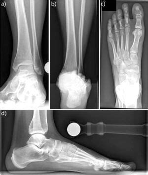 Hindfoot Radiographs Wikimsk