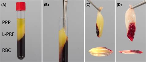 Fibrin Clot In Serum Sample