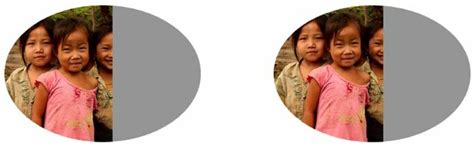 homonymous hemianopia   hand field  view  lost