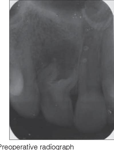 Figure 2 From Maxillary Lateral Incisors With Two Canals And Two Separate Curved Roots