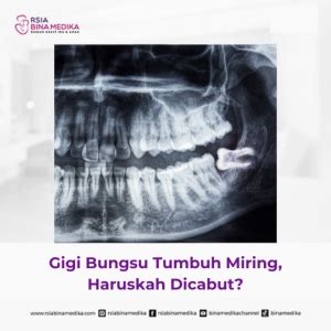 Gigi Bungsu Tumbuh Miring Haruskah Dicabut RSIA BINAMEDIKA