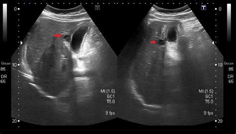 Figure 3 From Gallbladder Perforation Radiological Aspects Types And