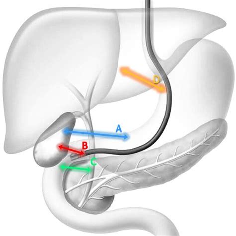 Pdf Endoscopic Ultrasound Guided Biliary Drainage In Malignant Distal