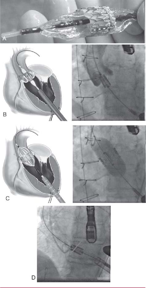 Figure 3 from Implantación transapical de la válvula aórtica Semantic