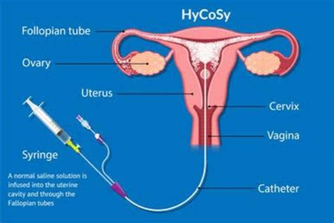 Hycosy Hsg Ftc Sonohsg Dr Samyutha Reddy Fertility Solutions