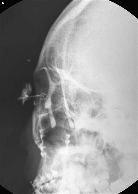 Nasolacrimal Duct Obstruction After Maxillary Orthognathic Surgery