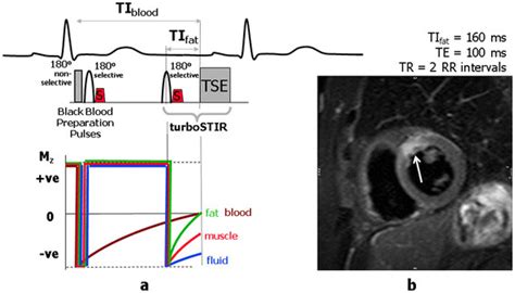 Triple Ir Preparation Scheme For Oedema Imaging Triple Inversion