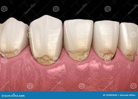 Abfraction Of Anterior Teeth Medically Accurate 3d Illustration