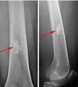 Tumore Alle Ossa Si Pu Guarire Sintomi E Sopravvivenza