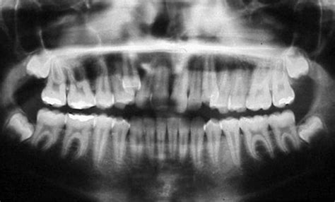 Chapter 3: Second molar extractions | Pocket Dentistry