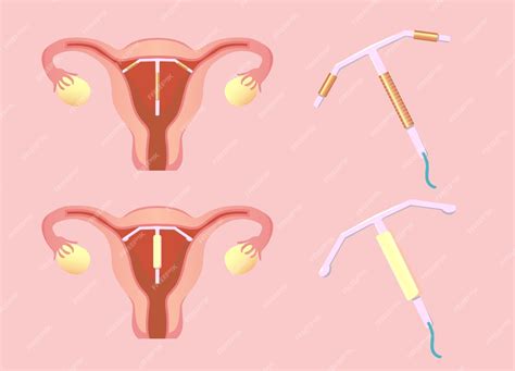 Premium Vector Intrauterine Device Iud On Flat Background Vector