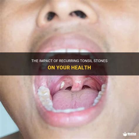 The Impact Of Recurring Tonsil Stones On Your Health Medshun