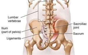 Sacroiliac Joint Dysfunction Treatment in Sydney | Podiatry First