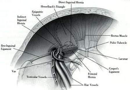 Direct Inguinal Hernia Anatomy