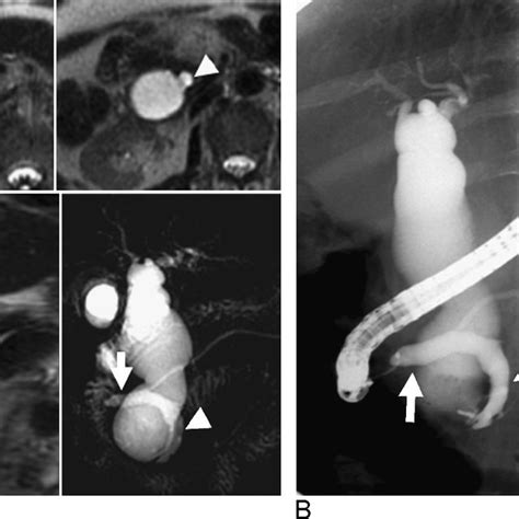 A 45 Year Old Man With A Choledochal Cyst Todani Type Ia With Apbdu Download Scientific