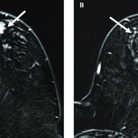 Pdf Significance Of Additional Non Mass Enhancement In Patients With