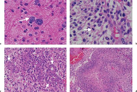 Malignant Gliomas Oncohema Key