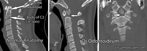 Os Odontoideum - Physiopedia