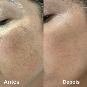 Line Skin Peeling de Fenol Máscara Clínica Bergmann