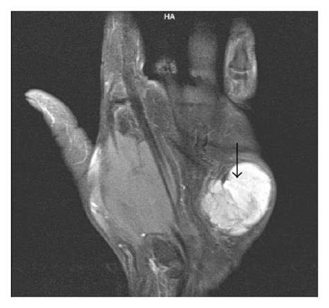 Synovial sarcoma. MRI (of the same patient as Figure 8). On T2W images ...