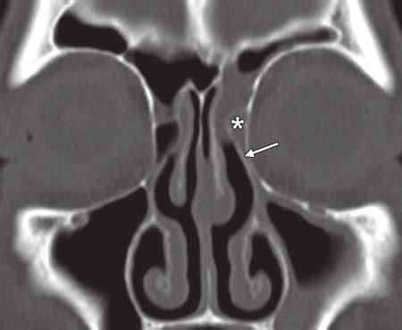 Retained uncinate process. Postoperative coronal CT image obtained ...