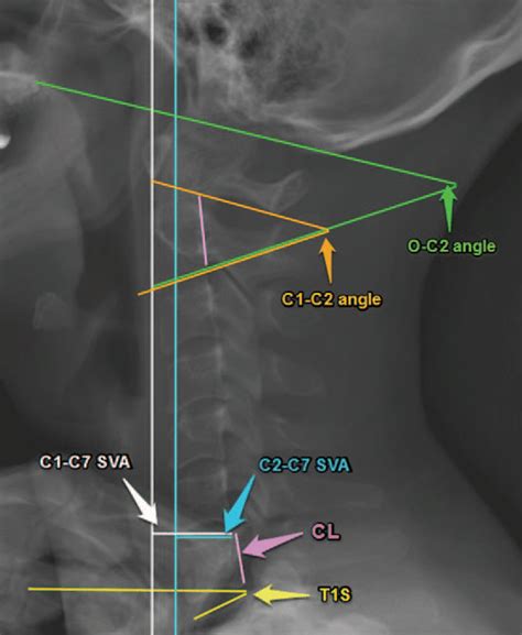 Loss Of The Cervical Curve DISABILITY – Professionally Integrated Care