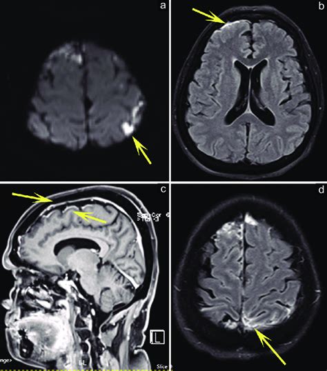 Contrast Mri Of Brain Showing A Bilateral Cortical Diffusion