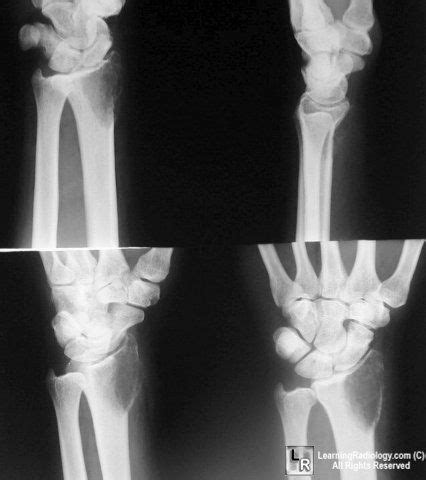 LearningRadiology - Giant Cell Tumor | Radiology imaging, Radiology ...