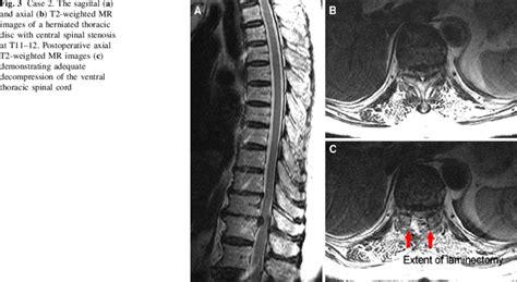 Case The Sagittal A And Axial B T Weighted Mr Images Of A