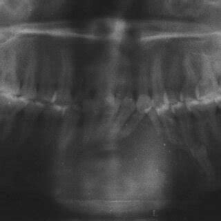 Orthopantomograph Of The Patient Before Treatment Wang Et Al