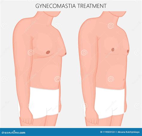 Human Body Anatomy Gynecomastia Treatment Stock Vector Illustration