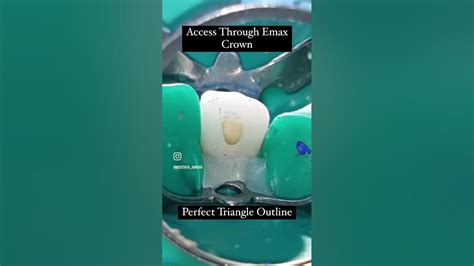 Access Cavity Outine For Upper Lateral Incisor Through Emax Crown