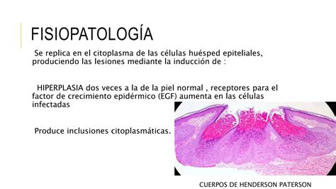 MOLUSCO CONTAGIOSO PPT