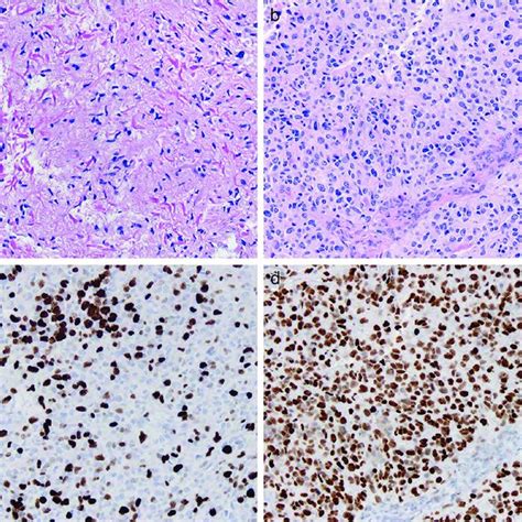 Aggressive Nature Of Diffuse Midline Gliomas With H3 K27m Mutation And